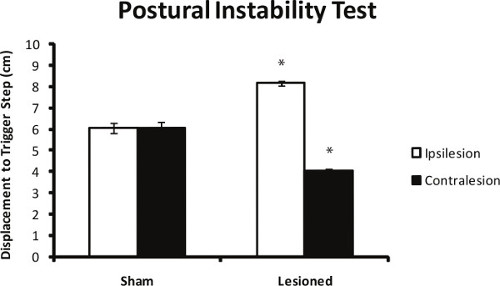 Postural Instability Test bar chart comparing ipsilesion and contralesion displacement results.