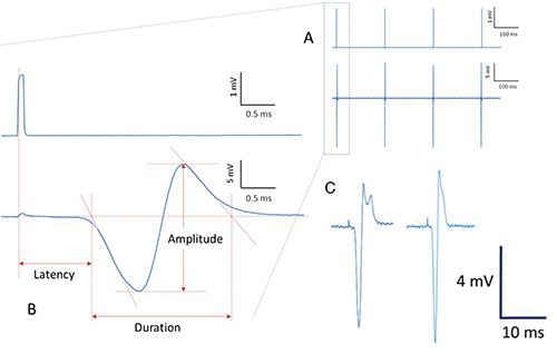 Neurophysiological signal analysis diagram: latency, amplitude, duration; waveform graphs.