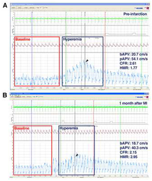 figure-results-4 Coronary flow reserve graph pre- and post-infarction; includes baseline and hyperemia phases.