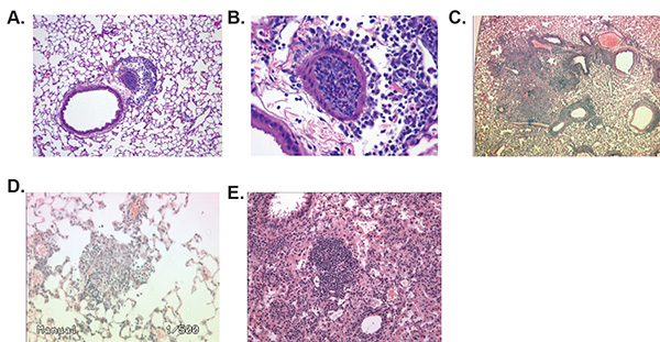 Histopathology slides showing lung tissue inflammation and cellular infiltration, microscopy analysis.