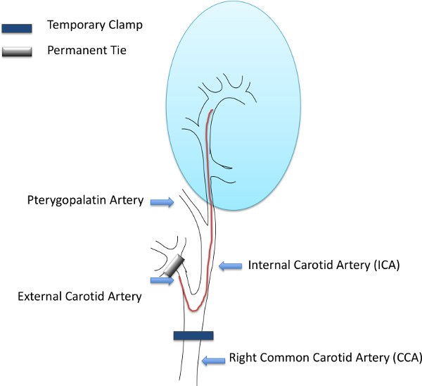 Carotid artery diagram with temporary clamp, permanent tie for surgical intervention process.