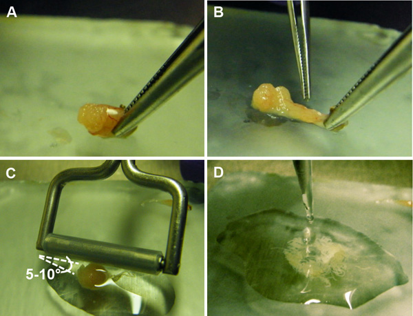 Tissue dissection process; image sequence with tweezers; surgical technique demonstration.
