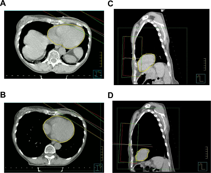 CT scan analysis; heart and chest regions outlined; segmentation method comparison; diagnostic imaging.