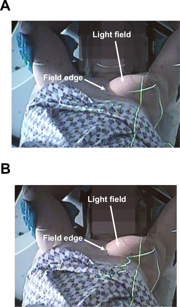 Radiation field setup, diagram showing light field and field edge for precision in radiotherapy.