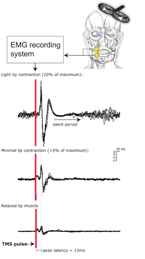figure-results-1 EMG recording, TMS pulse effect on lip muscle contraction; graph shows contraction levels and latency.