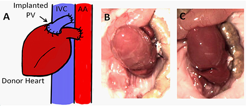 Heart transplant diagram with donor heart, blood vessels; surgical images of implant procedure.