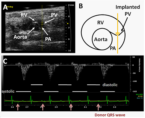 Cardiac ultrasound showing RV, PV, PA with diagram of implanted valve and waveform analysis.