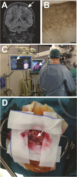 figure-results-1 Brain MRI, histological section, neurosurgery setup, and incision close-up for clinical study.