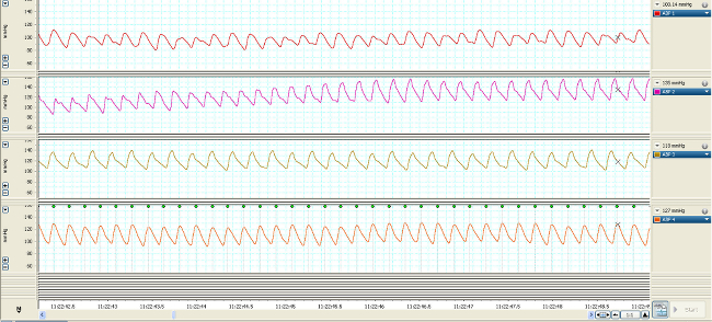 Heart rate monitoring graph; ECG signal analysis; data tracking over time; diagnostic chart.