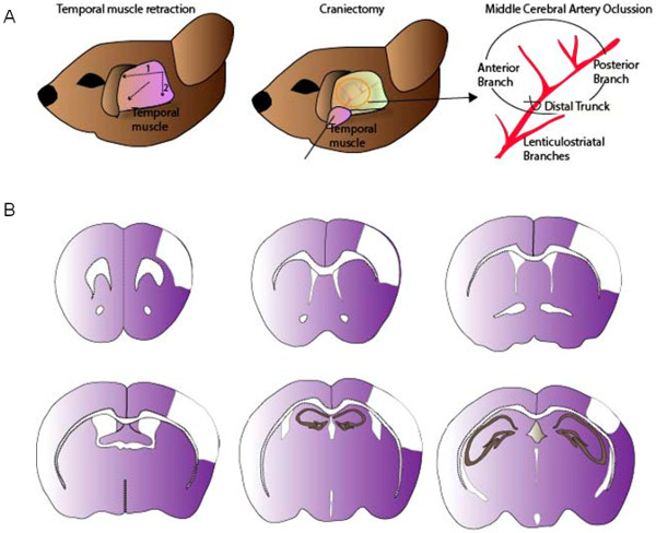 figure-results-1 Temporal muscle retraction, craniectomy method; brain cross-sections showing middle cerebral artery occlusion.
