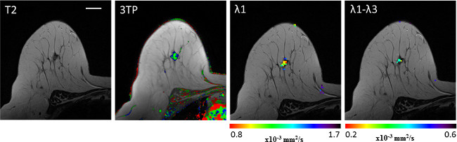 Brain MRI analysis, T2, 3TP, λ1, λ1-λ3 methods, diffusion maps, medical imaging results, tumor detection.