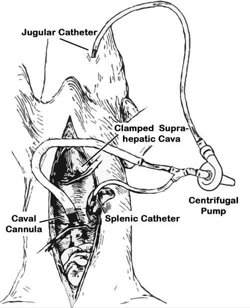 Equipment setup for liver bypass, showing catheters and centrifugal pump in surgical diagram.