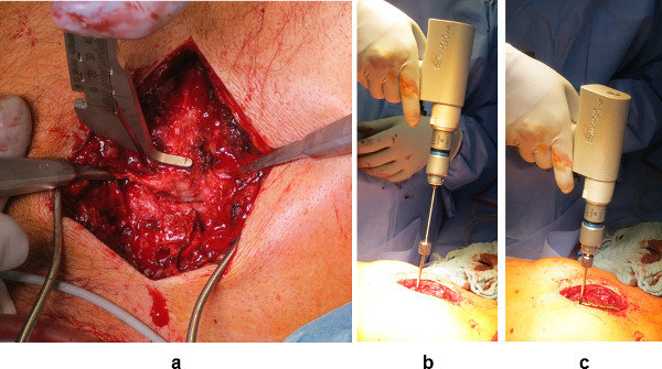 Intervention chirurgicale avec méthode de forage osseux ; outils de chirurgie orthopédique ; étapes de l’opération médicale.