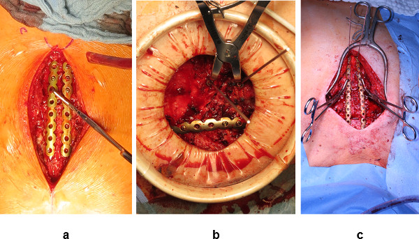 Intervention chirurgicale; stabilisation de la colonne vertébrale ; incision, outils, fixation métallique ; séquence de chirurgie orthopédique.