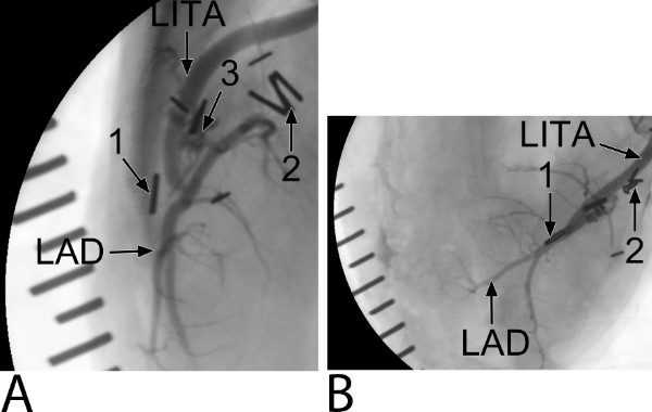 figure-results-7 Coronary angiography diagram, illustrating LITA to LAD bypass grafts for cardiac blood flow analysis.