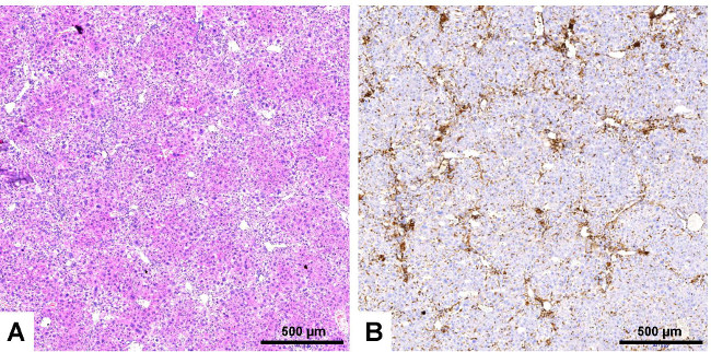Histology comparison, liver tissue slides; A: H&E stain, B: immunohistochemistry, cellular morphology.