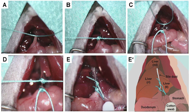 Surgical bile duct ligation sequence with anatomical drawing; liver, stomach, duodenum labeled diagram.