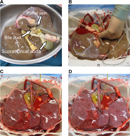 Liver transplantation procedure sequence showing portal vein, bile duct, supratruncal aorta.