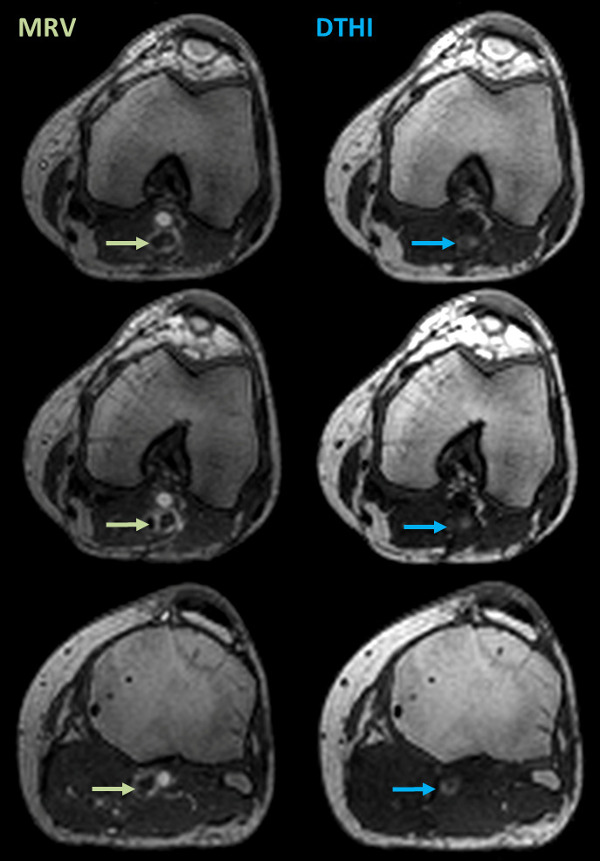 Porównanie MRI modalności MRV i DTHI w stawie kolanowym; obrazowanie medyczne, analiza anatomiczna.