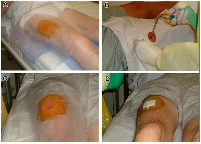 figure-results-2 Aseptic technique sequence, knee injection procedure, sterile setup, medical procedure steps.