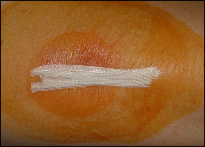 figure-results-3 Wound closure diagram, showing skin with Steri-Strips for surgical incision healing post-procedure.