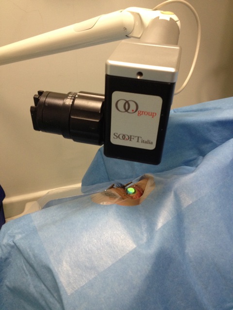 Surgical microscopy setup for precision procedure, featuring optical equipment and patient draping.