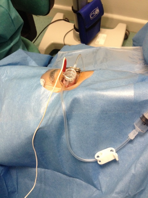Surgical setup for retinal procedure; eye surgery equipment illustrating microsurgical technique.
