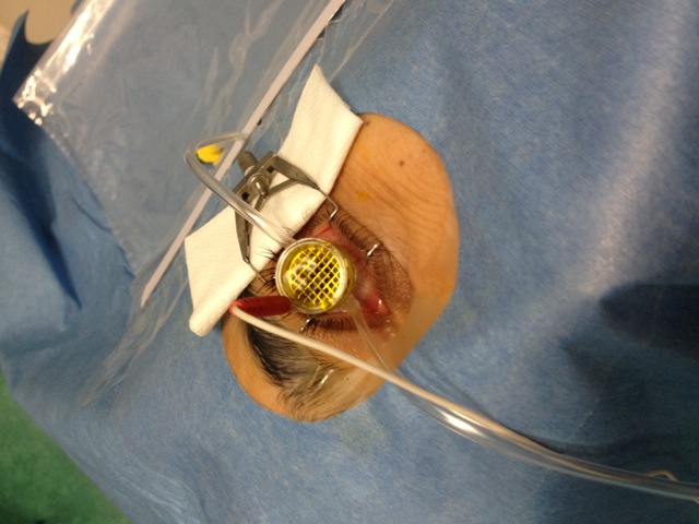 Eye surgery setup with speculum and tubing for ophthalmic procedure.