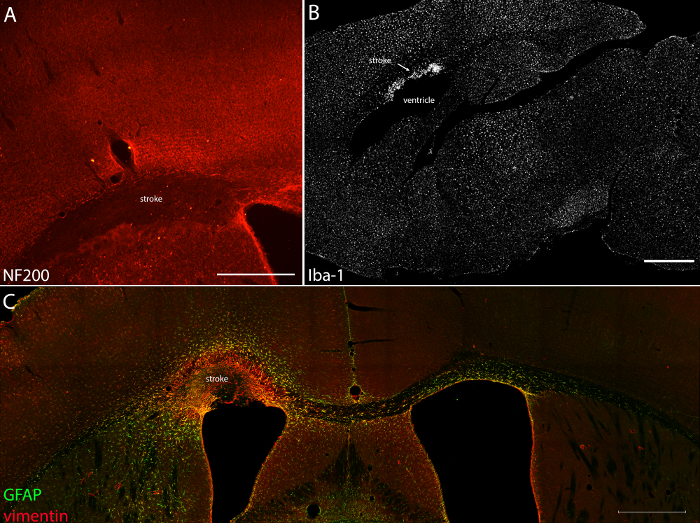 Brain stroke microscopy; immunolabeling diagram: NF200, Iba-1, GFAP, vimentin cell analysis.