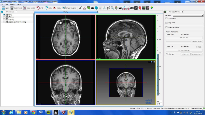 MRI brain scan analysis using medical imaging software, displaying cross-sectional views and data.