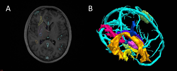 Brain MRI scan and 3D reconstruction; anatomy visualization, diagnostic imaging, neural mapping.