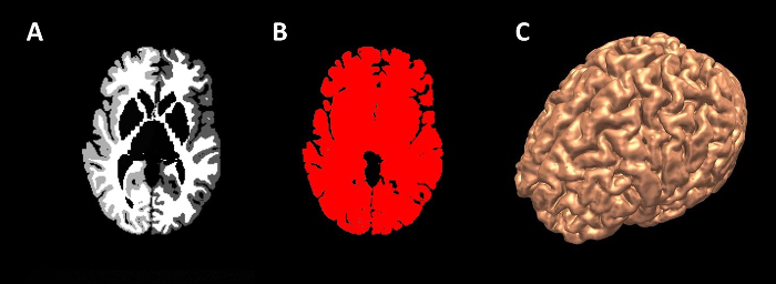 Brain imaging analysis; MRI scan segmentation; 3D reconstruction; neuroimaging technique.
