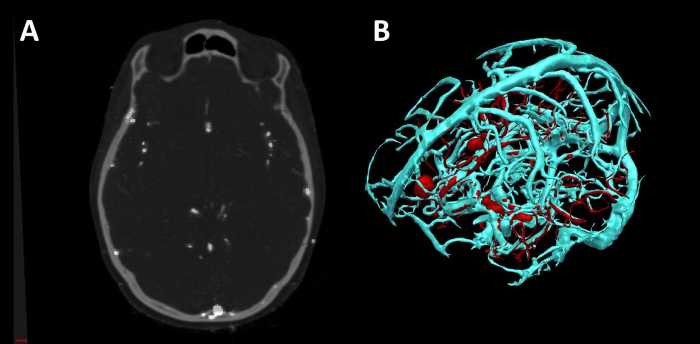 CT angiography; brain vascular structure visualization; medical imaging analysis.
