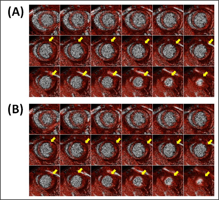 Cardiac MRI sequences with contrast enhancement; dynamic imaging; arrows indicate progress.