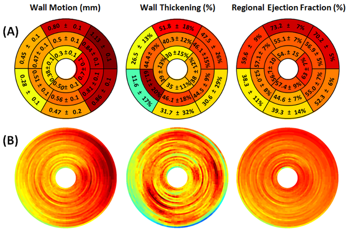 Cardiac function analysis; circular heatmaps for wall motion, thickening, ejection; visualization.