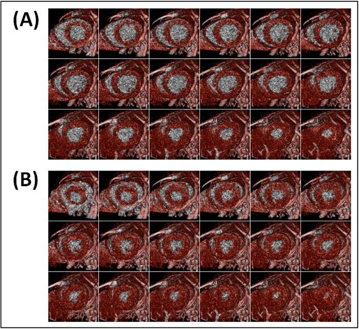 MRI dynamic heart study; sequences showing cardiac cycles, motion capture, red-blue contrast.