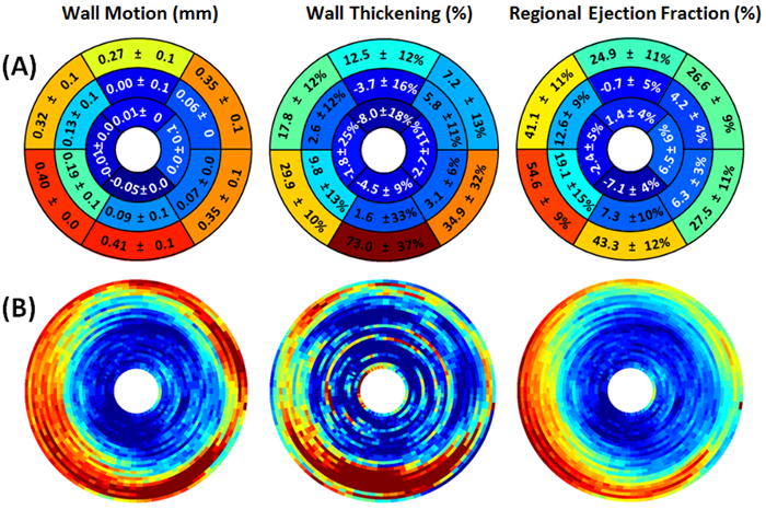 Cardiac function analysis using polar maps and heatmaps; wall motion, thickening, ejection fraction.