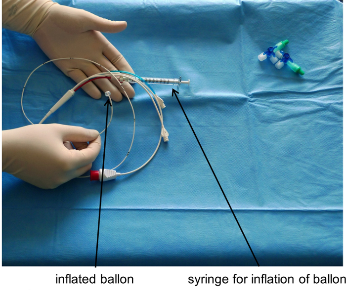 Balloon catheter inflation setup; syringe and catheter on medical tray for procedural demonstration.