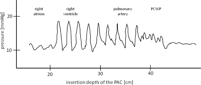 Pulmonary artery catheterization pressure graph, insertion depth vs pressure.