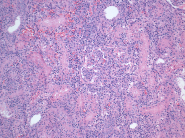 Histology slide, kidney tissue, light microscopy, cells, purple and pink stain, medical analysis.