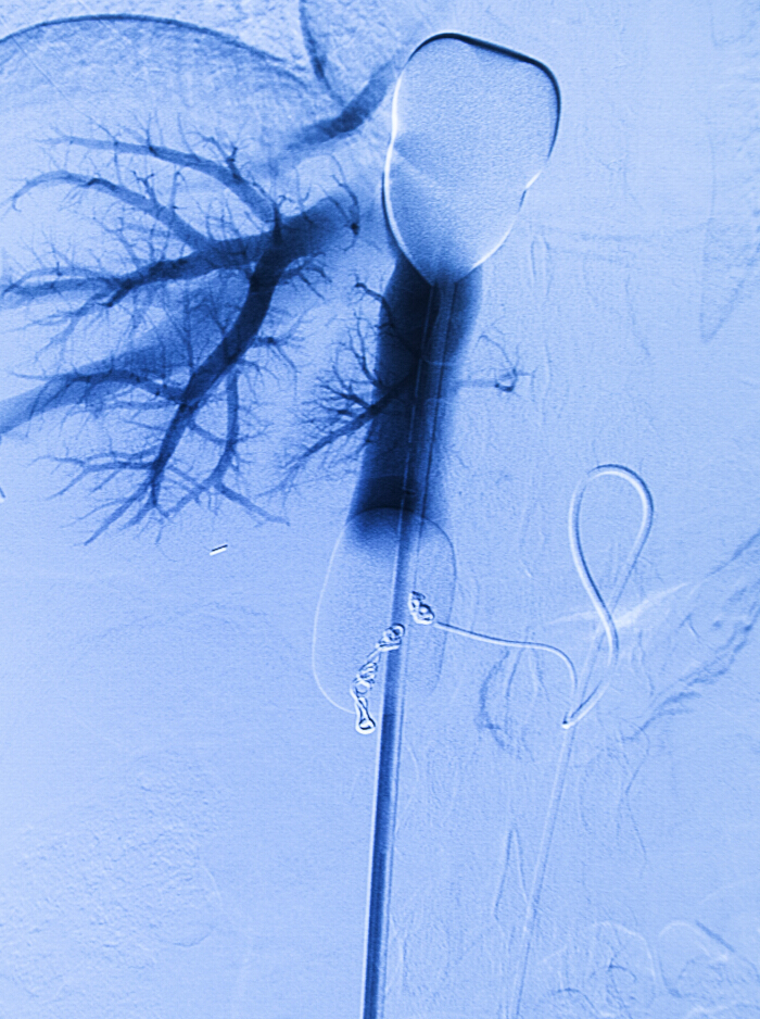 Angiography image showing vascular structure with catheter for blood flow analysis.