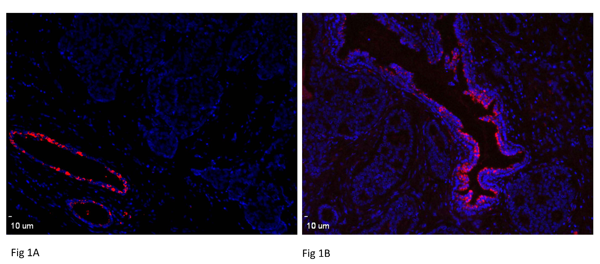 Clinicopathological Analysis of miRNA Expression in Breast Cancer ...