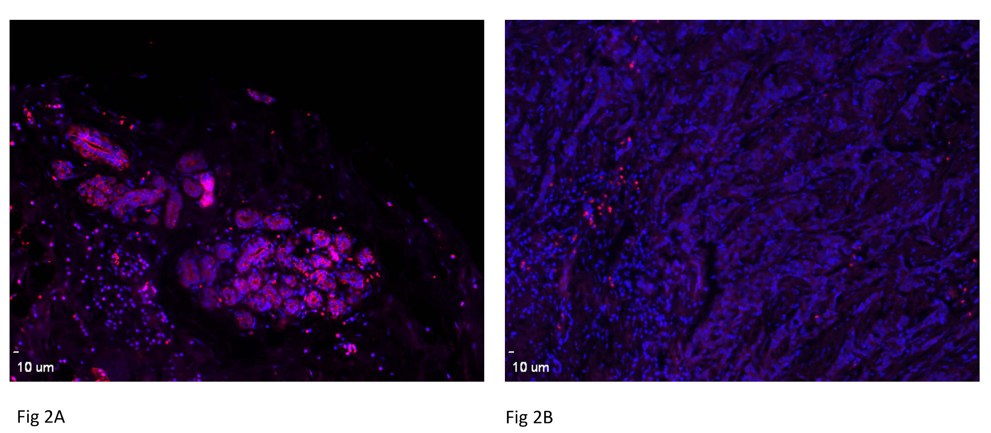 Clinicopathological Analysis of miRNA Expression in Breast Cancer ...