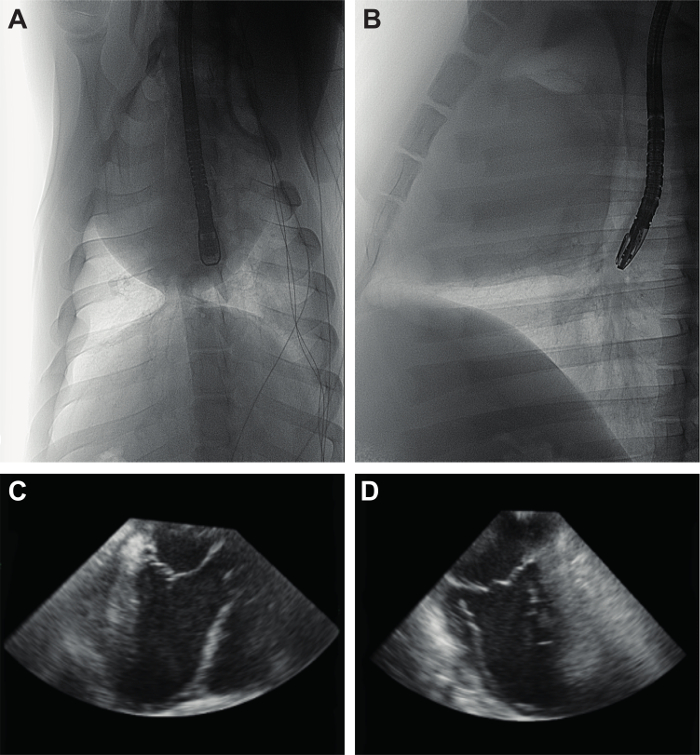 Endoscopic ultrasound images; chest X-rays showing endoscope in esophagus; A and B, ultrasound C and D.