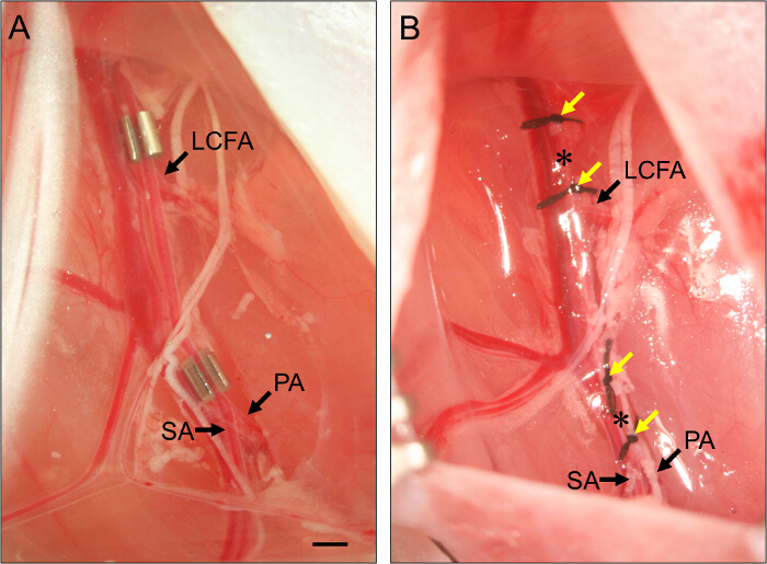 Surgical diagram with labeled arteries for vascular study; LCFA, PA, SA highlighted with markers.
