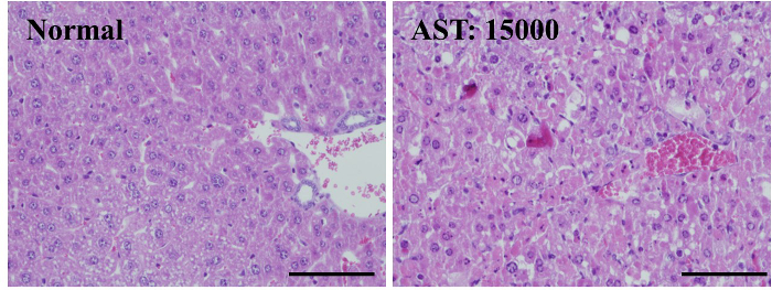Liver histology comparison, normal vs. elevated AST at 15000, microscope image analysis.