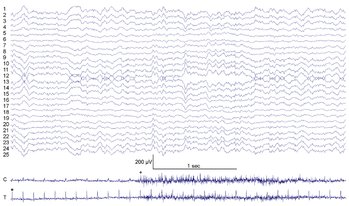figure-results-3 EEG waveforms diagram, brain activity measurement, neurological analysis, 25 channels, μV scale.