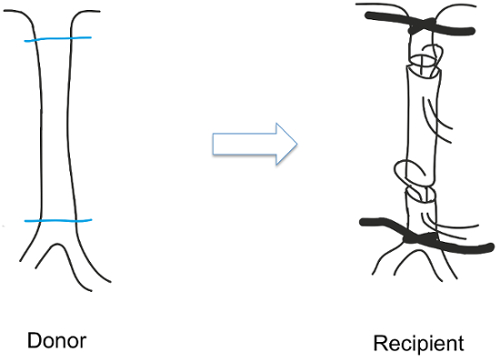 figure-results-1 Blood vessel transplant diagram; donor to recipient grafting process in vascular surgery.
