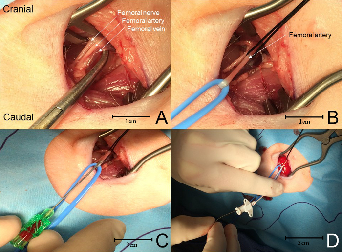 Femoral artery cannulation procedure, labeled diagram; catheter insertion technique shown in surgical setup.