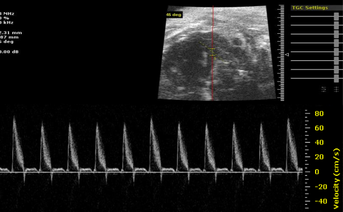 Cardiac Doppler ultrasound, velocity chart, flow measurement, echocardiography waveform analysis.